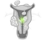 توده های زیر پوست
